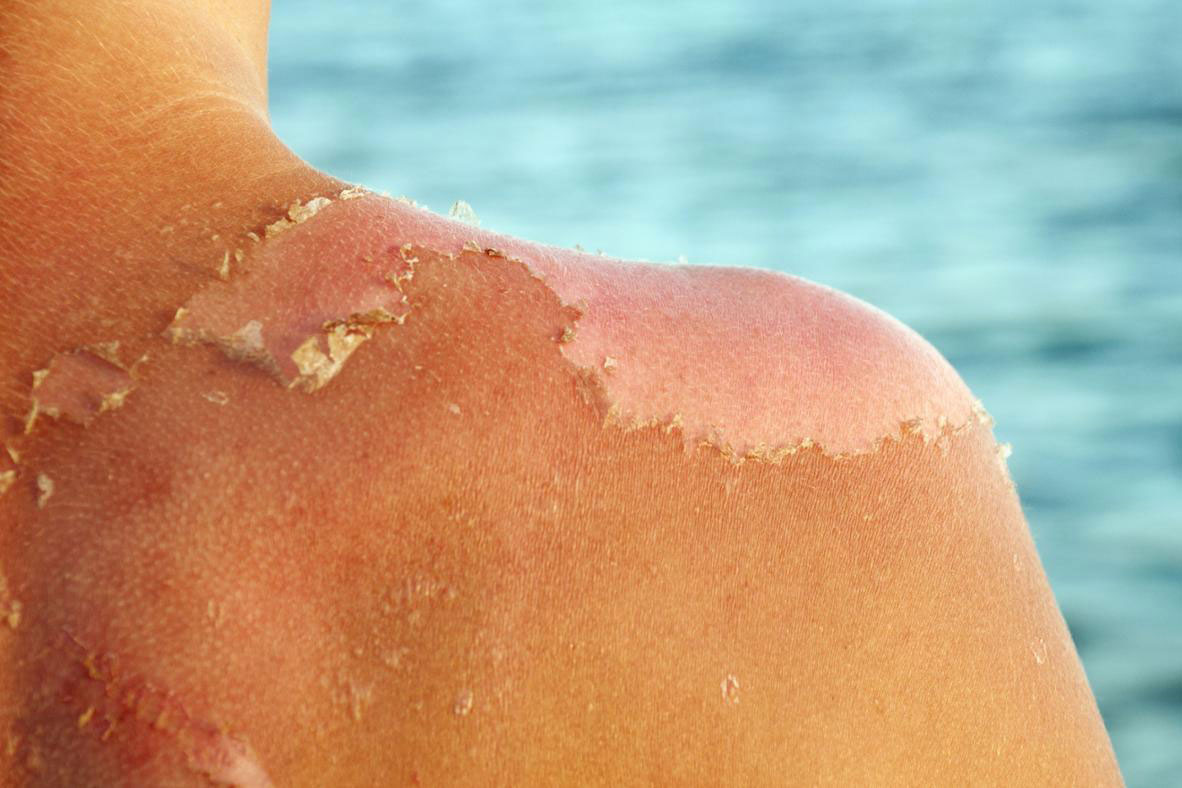 Tác hại kinh khủng của tia UV đối với làn da