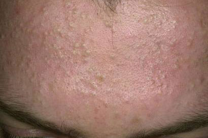 Những bước cần thiết để xử lý và ngăn ngừa mụn ẩn dưới da
