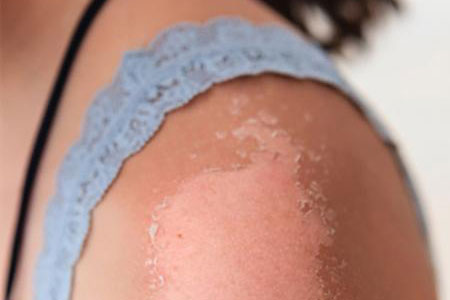 Tác hại kinh khủng của tia UV đối với làn da